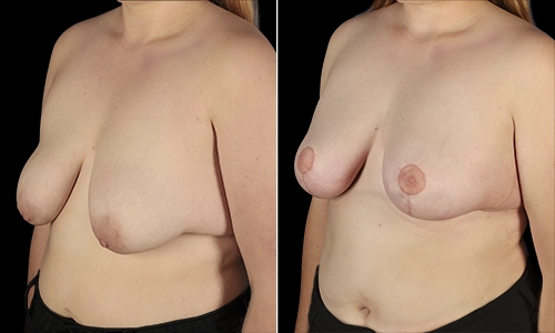 Breast Lift Before and After - Joyce Aycock Patient 5 - 3/4 View Left Facing
