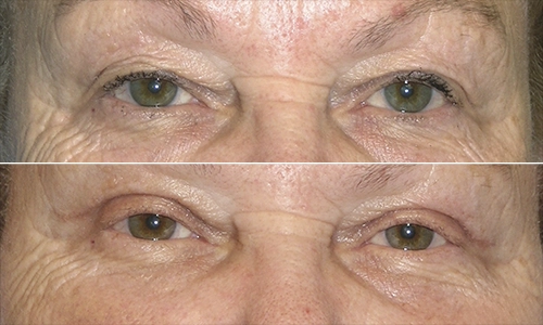 Eyelid Lift Before and After - Joyce Aycock Patient 2 - Front View