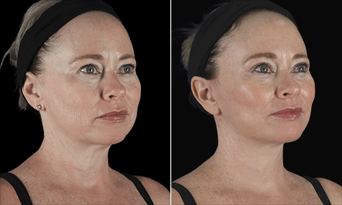Facelift Before and After - Joyce Aycock Patient 5 - 3/4 View Right Facing