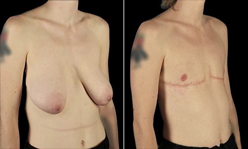 Top Surgery Before and After - Joyce Aycock Patient 5 - 3/4 View Right Facing