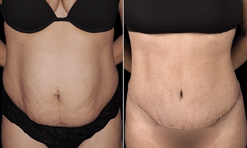 Tummy Tuck Before and After - Joyce Aycock Patient 11 - Front View