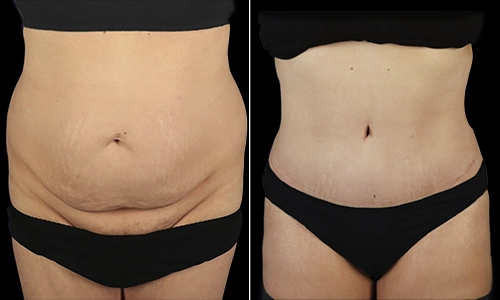 Tummy Tuck Before and After - Joyce Aycock Patient 3 - Front View