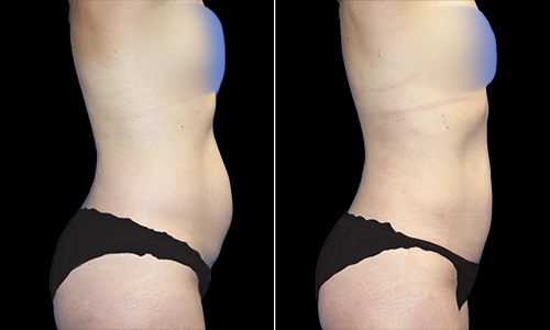 Tummy Tuck Before and After - Joyce Aycock Patient 7 - Side View Upright