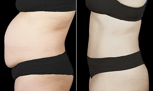 Tummy Tuck Before and After - Joyce Aycock Patient 9 - Side View Upright